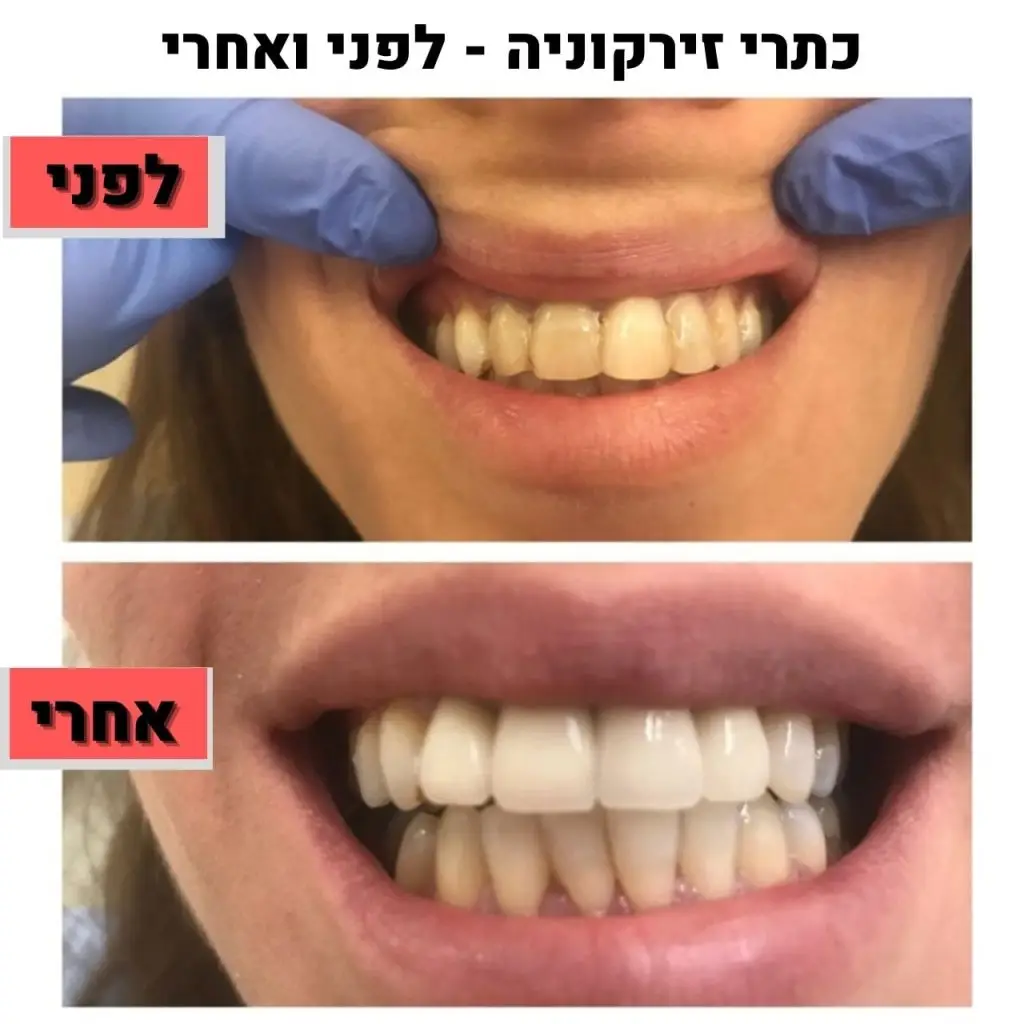 כתר זירקוניה לפני ואחרי ד"ר זילברשר