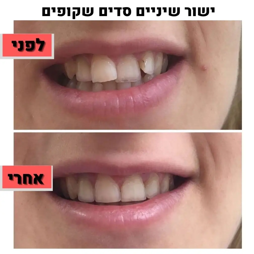 יישור שיניים סדים שקופים | ד"ר זילברשר