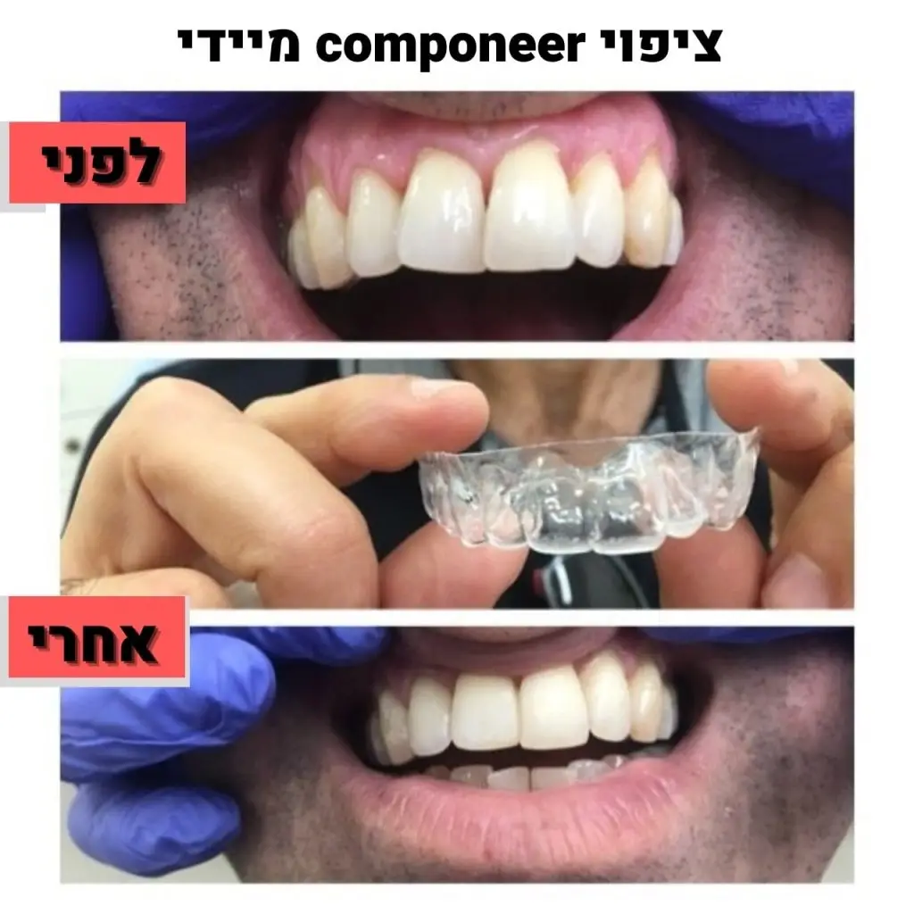 ציפוי componeer מיידי | ד"ר זילברשר