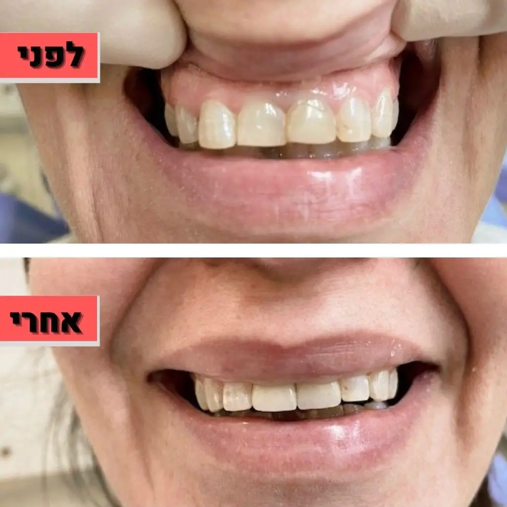 ציפוי למינייט | ציפוי חרסינה לשיניים | ד"ר זילברשר