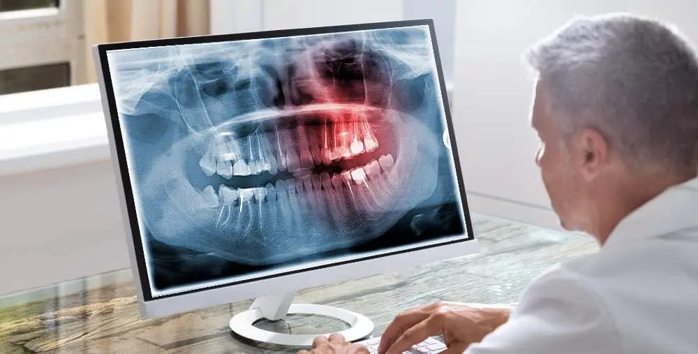הרמת סינוס | ד"ר זילברשר מרפאת מומחים