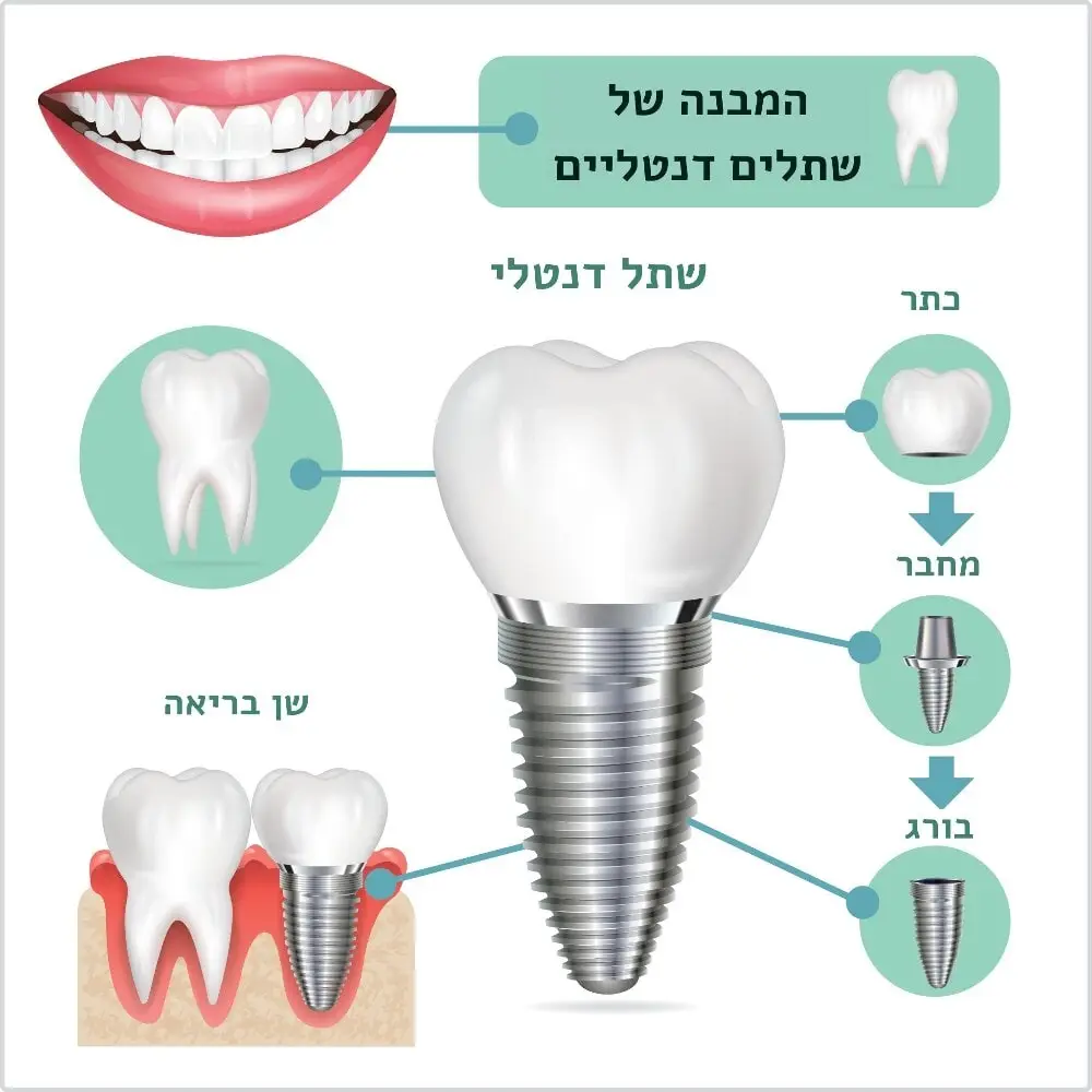 מבנה שתלים בשיניים ד"ר זילברשר