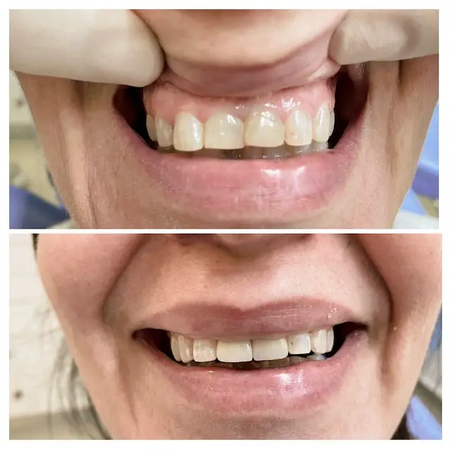 ציפויי שיניים חרסינה לפני ואחרי