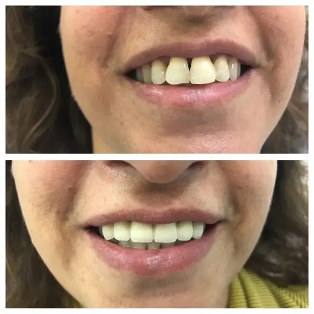 כתר זירקוניה לפני ואחרי | זילבקשר