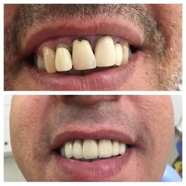 כתר זירקוניה | מרפאת ד"ר זילברשר