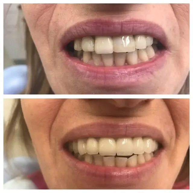 כתר זירקוניה | מרפאת ד"ר זילברשר