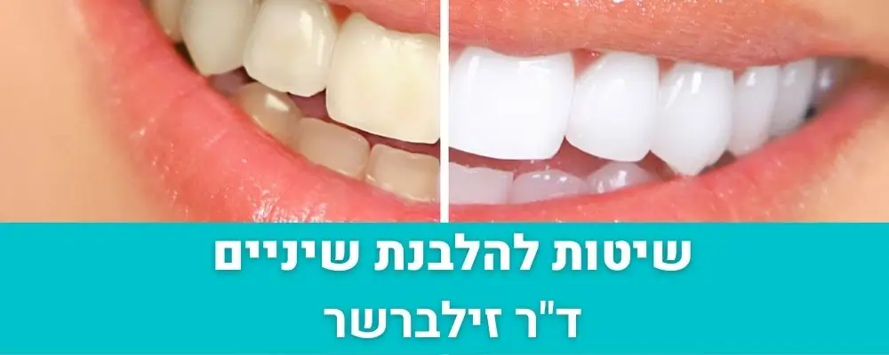 שיטת להלבנת שיניים