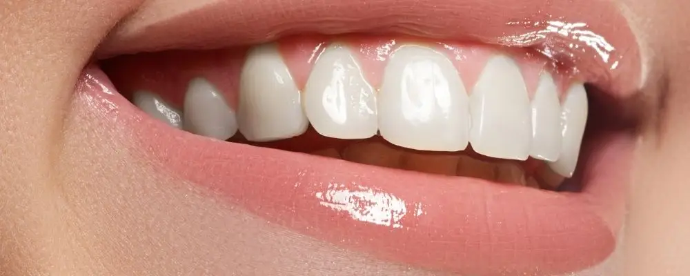 הלבנת שיניים