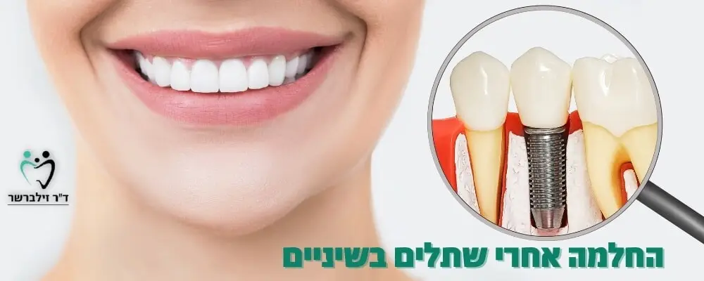 החלמה אחרי שתלים בשינים | ד"ר זילברשר