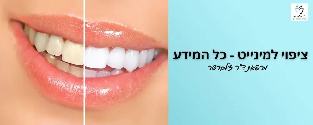 ציפוי למינייט