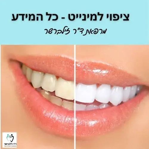ציפוי למינייט - כל המידע