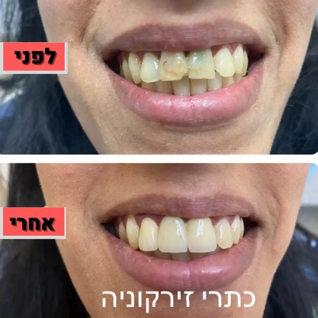 שיקום הפה כתר זירקוניה | מרפאת ד."ר זילברשר