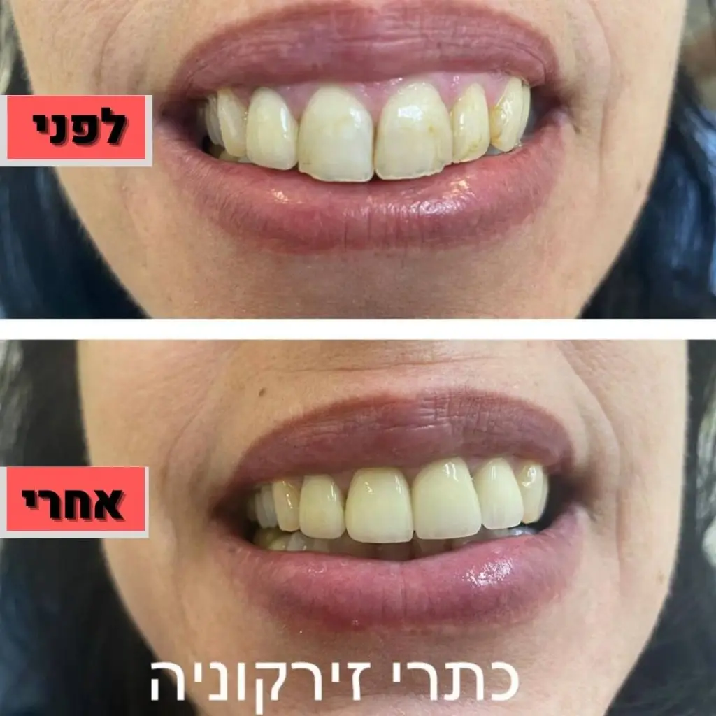 שיקום פה ולסת כתרי זירקוניה | ד"ר זילברשר