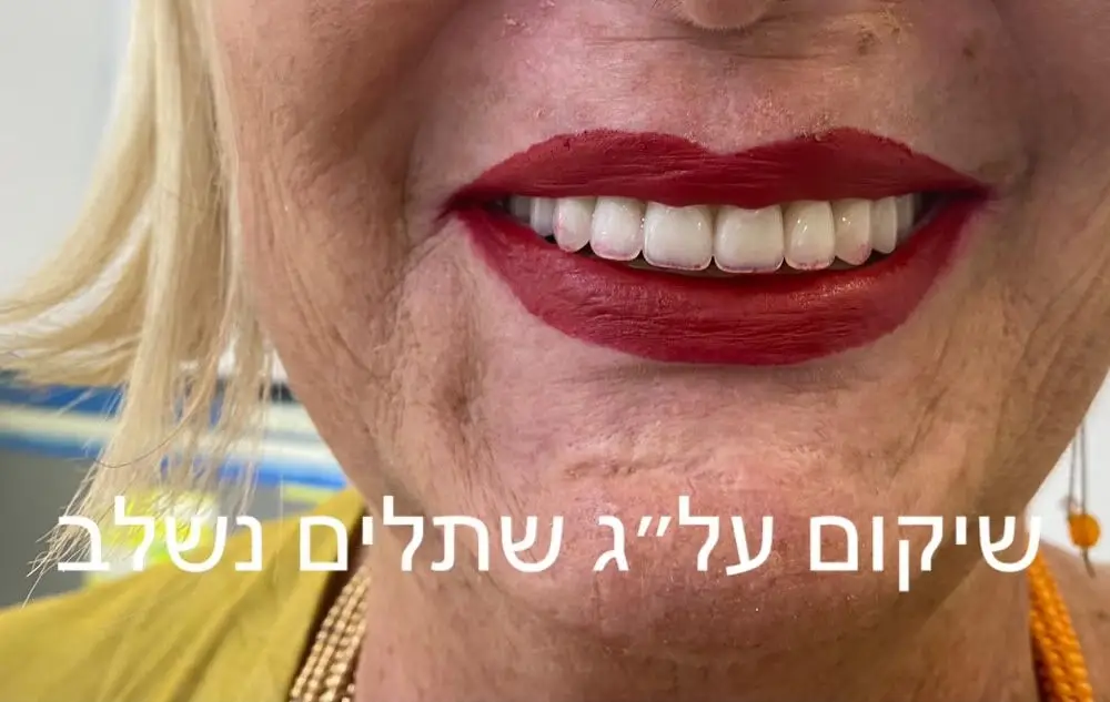 שיקום על גבי שתלים ד"ר זילברשר