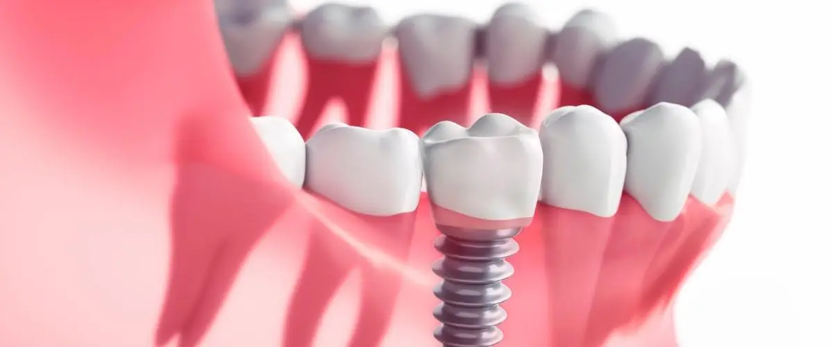 שתלים דנטליים - אילוסטרציה