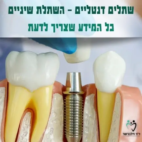 שתלים דנטליים | השתלת שיניים | כל מה שצריך לדעת