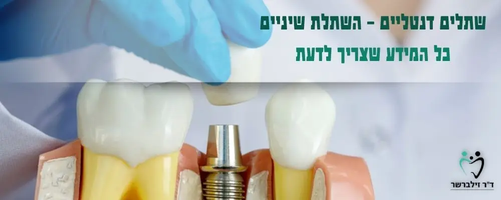 שתלים דנטליים | השתלת שיניים | כל מה שצריך לדעת