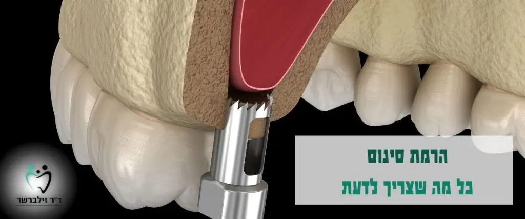 הרמת סינוס כל מה שצריך לדעת | ד"ר זילברשר