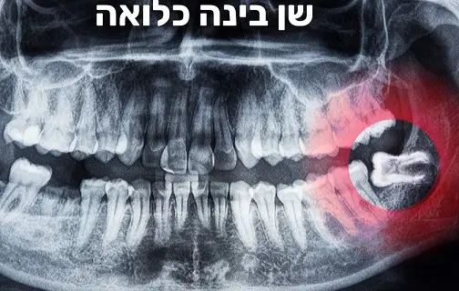 שן בינה כלואה